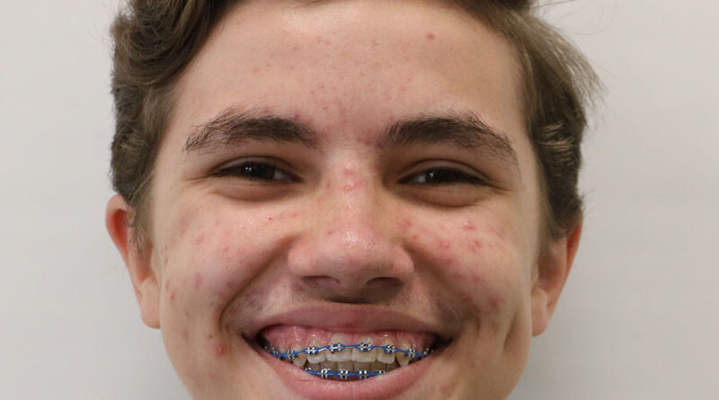 twinks with braces