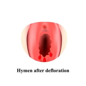 cody joens recommends Defloration Of The Hymen