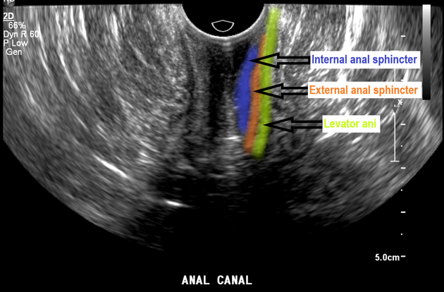 Anal Acident n tug