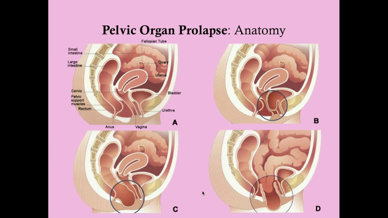 allen hewitt recommends prolapse porn pic