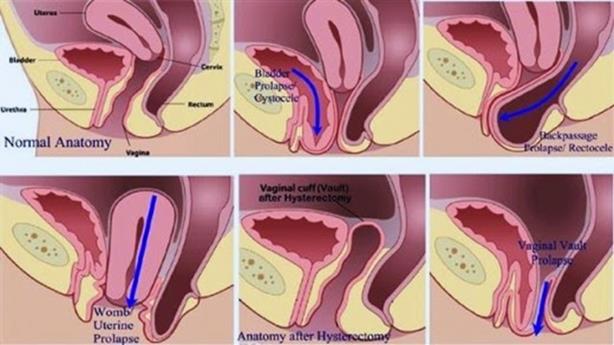 cassie bailie recommends prolapse porn pic