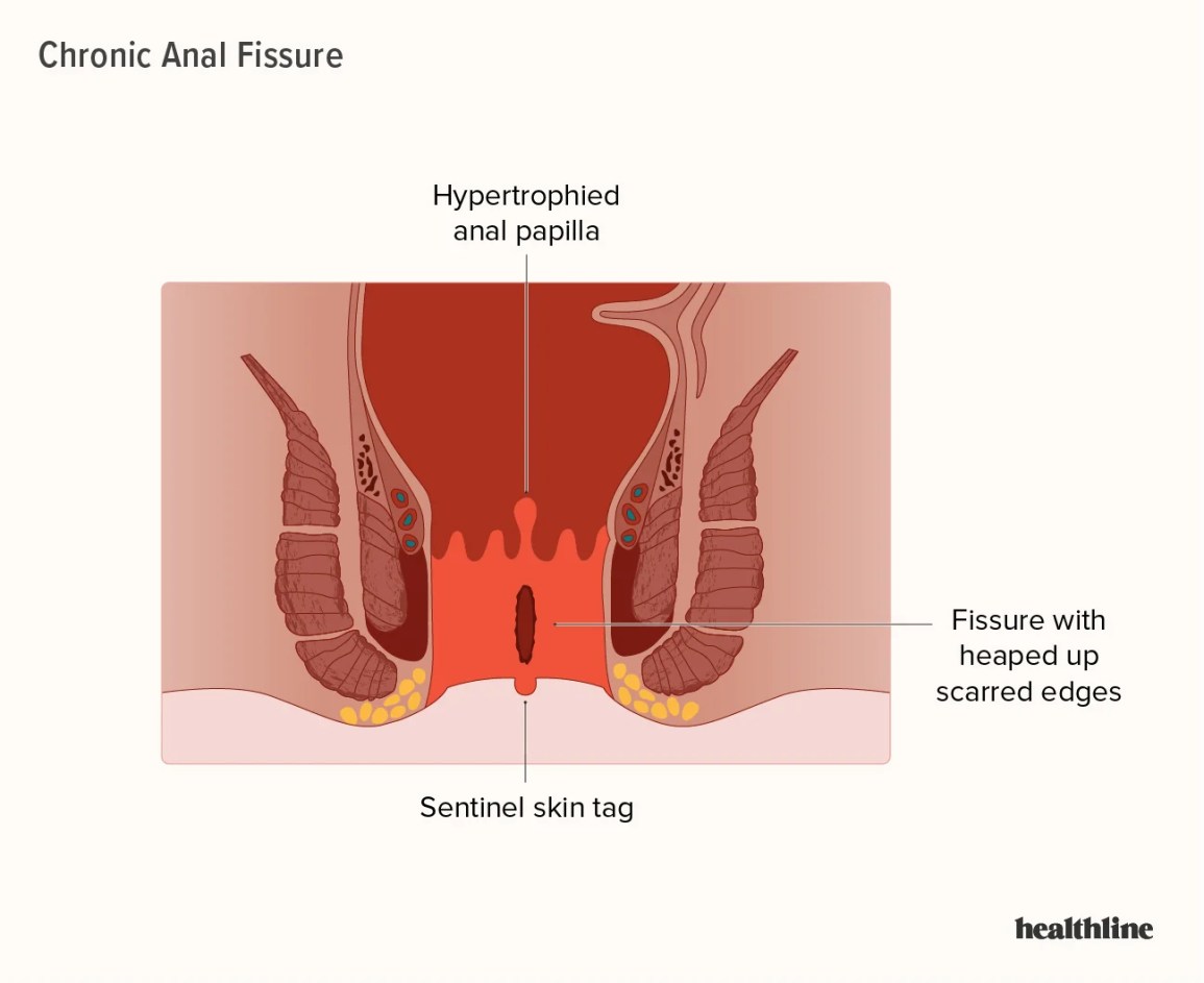 andreas kourtis recommends anal painal pic