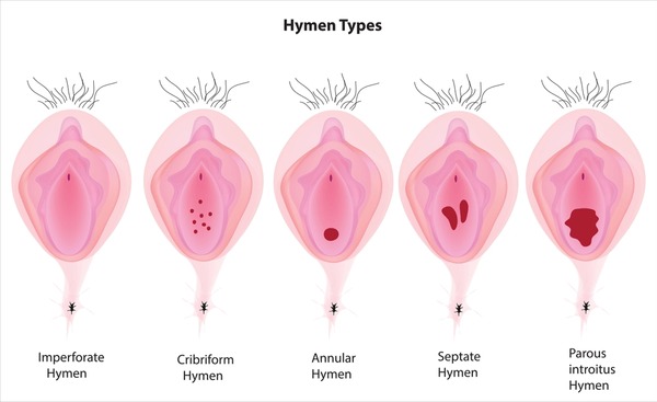 cassandra katz recommends defloration of the hymen pic