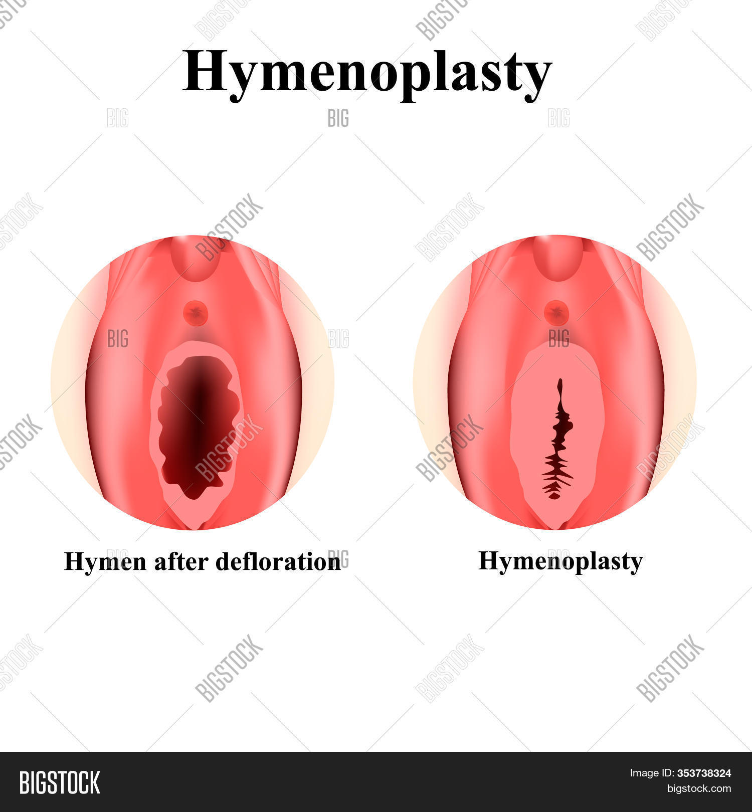 Defloration Of The Hymen lesbiangif pussylicking