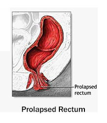 Best of Prolapse porn